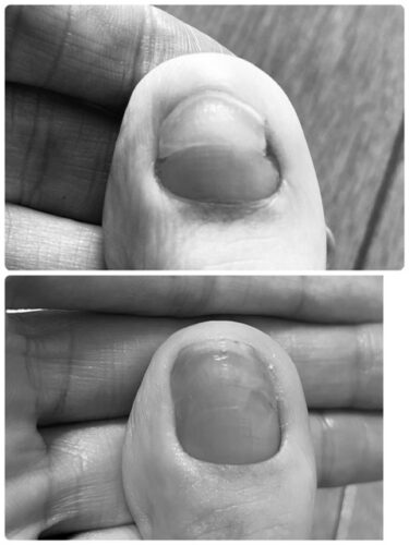 ２重爪の治療